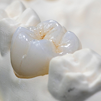 Step 6: Finished dentures